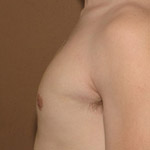 Gynecomastia Correction - Before And After Pictueres
