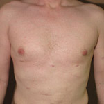 Gynecomastia Correction - Before And After Pictueres