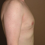 Gynecomastia Correction - Before And After Pictueres