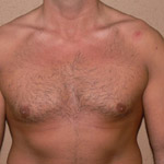 Gynecomastia Correction - Before And After Pictueres