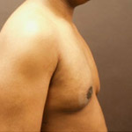 Gynecomastia Correction - Before And After Pictueres
