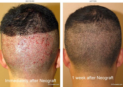 Hair transplantation