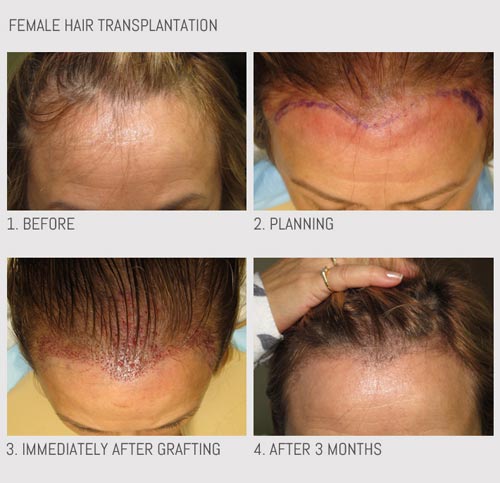 Hair transplantation