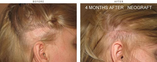 Hair transplantation