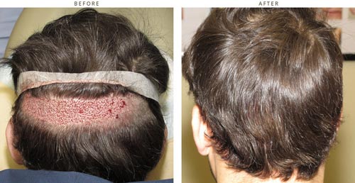 Hair transplantation
