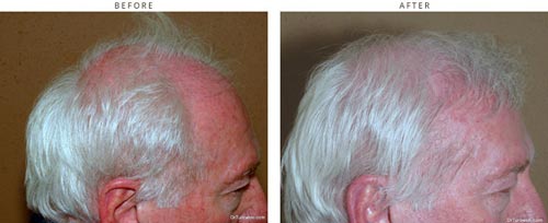 Hair transplantation