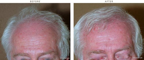 Hair transplantation