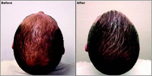 Hair transplantation