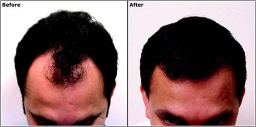 Hair transplantation