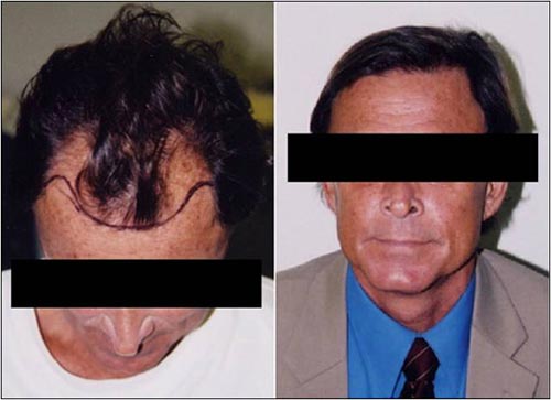 Hair transplantation