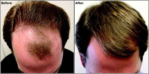 Hair transplantation