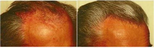 Hair transplantation