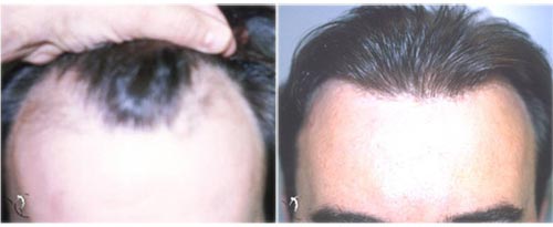 Hair transplantation