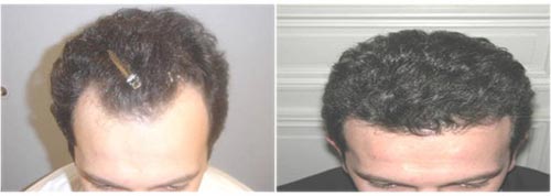 Hair transplantation