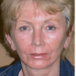 Laser Resurfacing - Before And After Pictueres