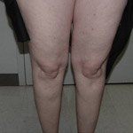 Laser Vein Removal - Before And After Pictueres