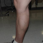 Laser Vein Removal - Before And After Pictueres