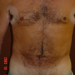 Liposuction - Before And After Pictueres