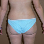 Liposuction - Before And After Pictueres