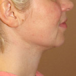 Liposuction - Before And After Pictueres