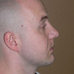 Liposuction - Before And After Pictueres