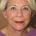 Mid Face Lift - Before And After Pictueres