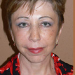 Mid Face Lift - Before And After Pictueres