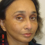 Mid Face Lift - Before And After Pictueres