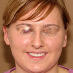 Otoplasty - Before And After Pictueres