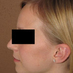 Otoplasty - Before And After Pictueres