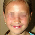 Otoplasty - Before And After Pictueres