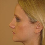Rhinoplasty - Before And After Pictueres