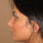 Rhinoplasty - Before And After Pictueres