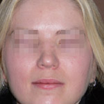 Rhinoplasty - Before And After Pictueres