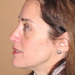 Rhinoplasty - Before And After Pictueres