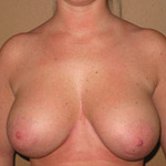 Scarless Internal Breast Lifting - Before And After Pictueres