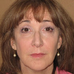 Sculptra - Before And After Pictueres