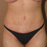 Tummy Tuck - Before And After Pictueres