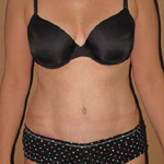 Tummy Tuck - Before And After Pictueres