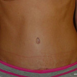 Tummy Tuck - Before And After Pictueres