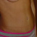 Tummy Tuck - Before And After Pictueres