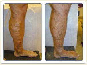 Varicose veins and broken vessels removal
