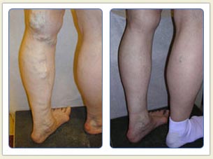 Varicose veins and broken vessels removal
