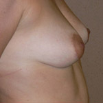 Vertical Mastopexy - Before And After Pictueres